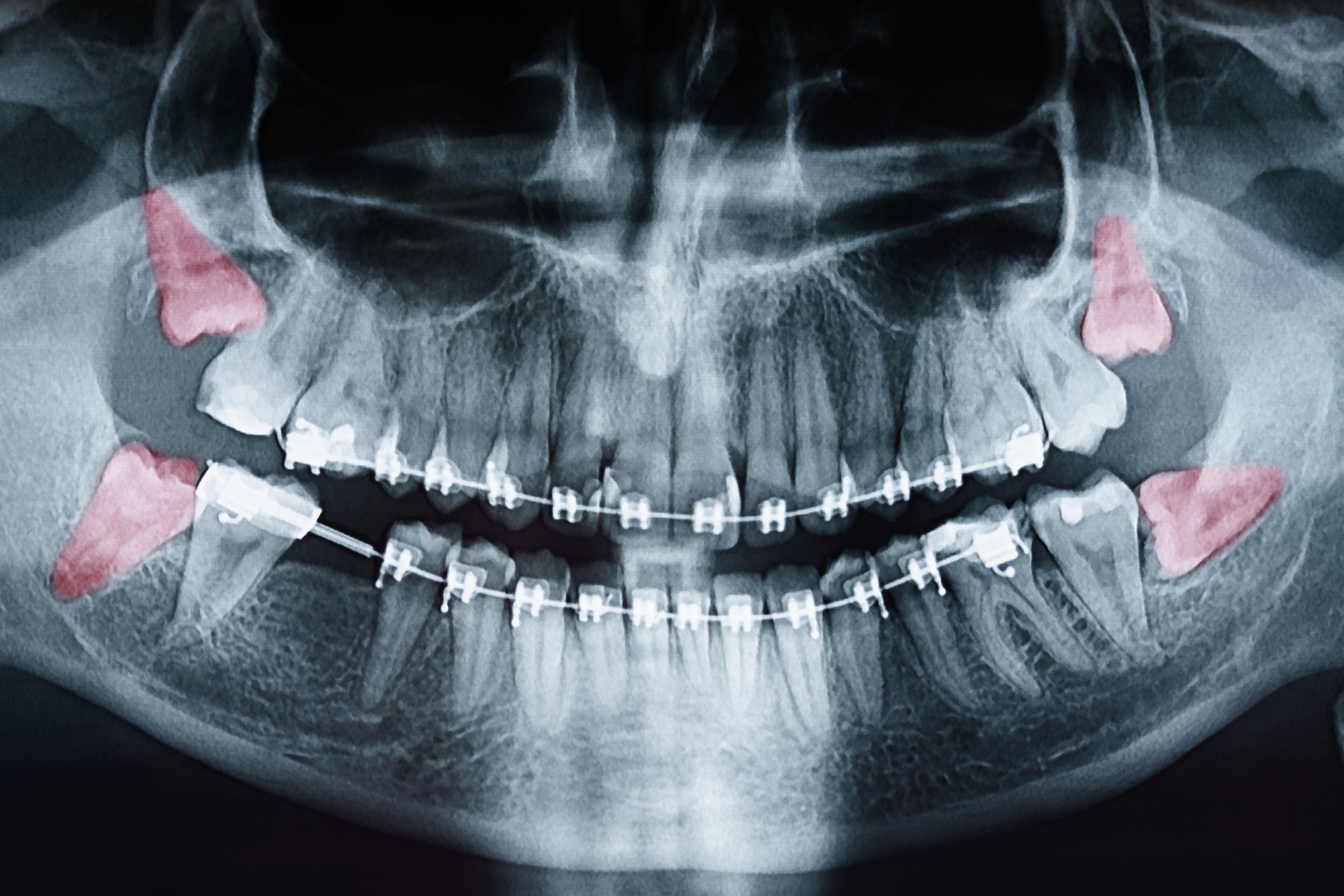 Oral Surgery at The Smile Spa in Agoura Hills, CA — Can You Get Dry Socket After Wisdom Teeth Removal?